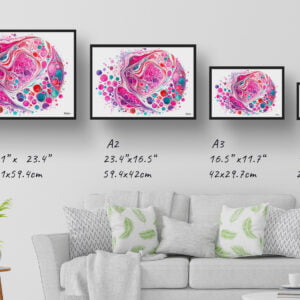 dream watercolour micrograph of follicular thyroid carcinoma circular print size comparison